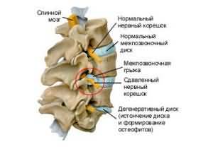 Как выглядить грыжа внутри