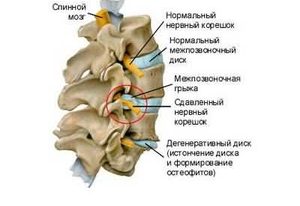 Специальный пояс для поддержки живота после удаления пупочной грыжи у новорожденных.