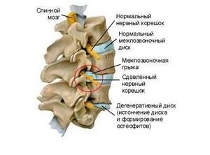 упражнение при поясничной грыже