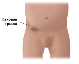 операция паховой грыжи у ребенка.html